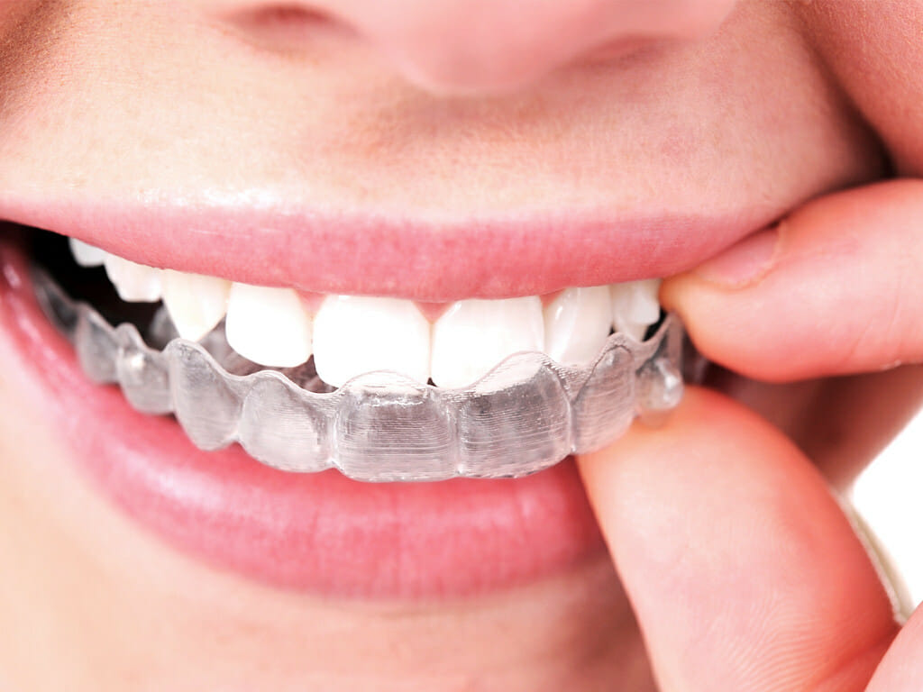 An Invisalign being worn by our patient