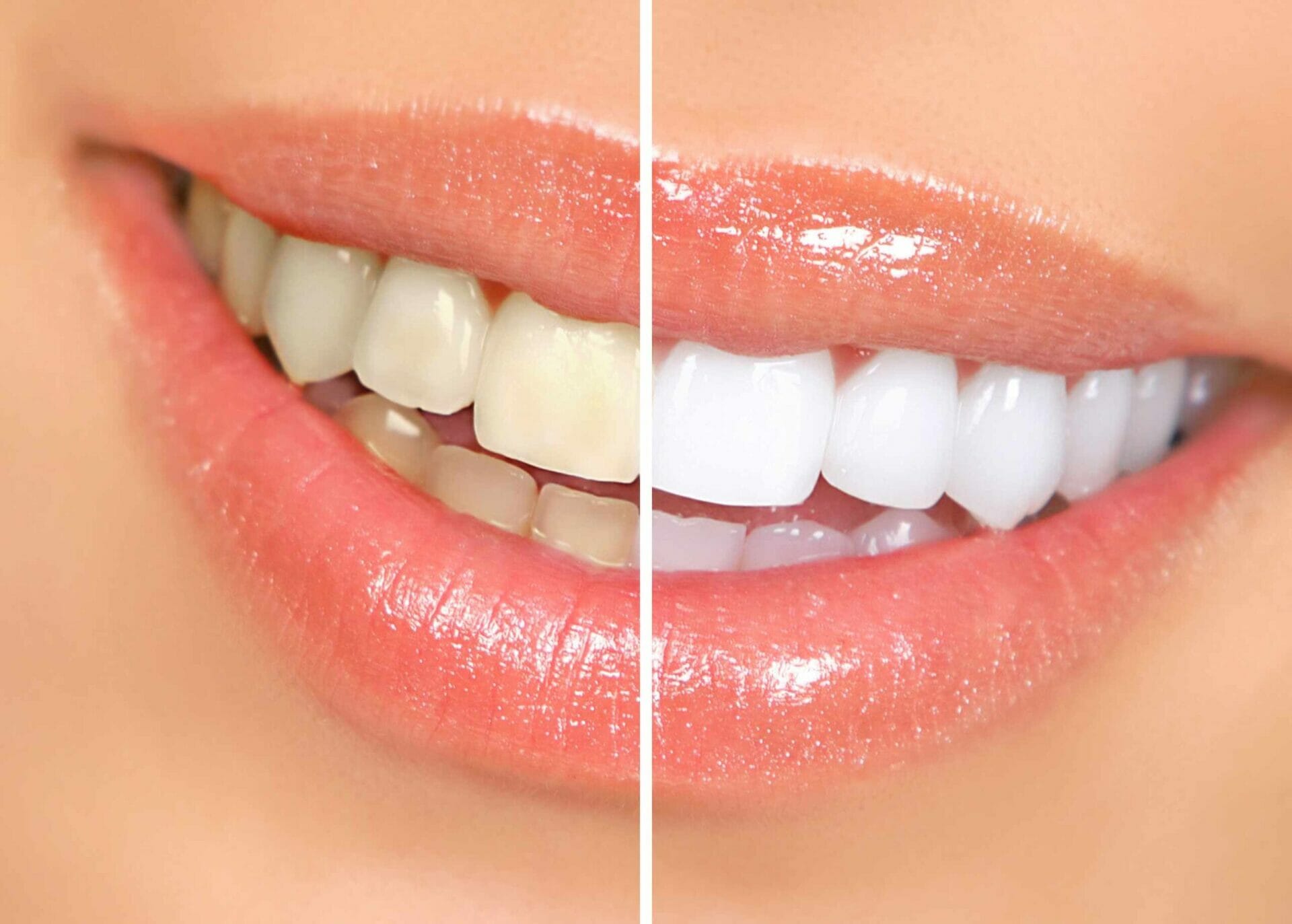 teeth-whitening bhd