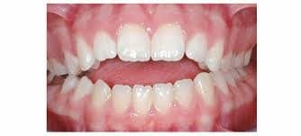 Missing Lateral Incisors Causes and Treatment