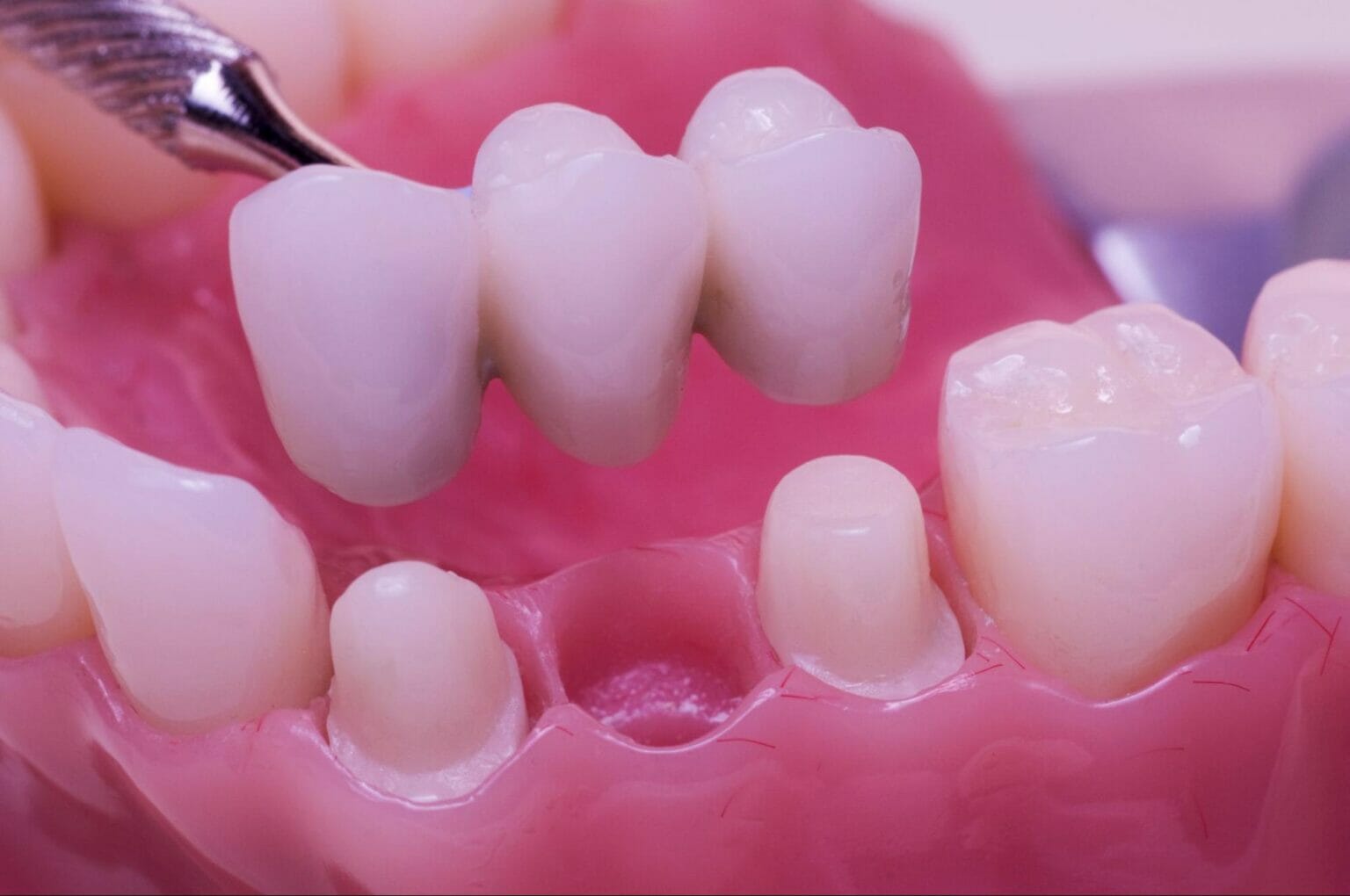 The Importance of Good Oral Hygiene with Dental Bridges A Complete