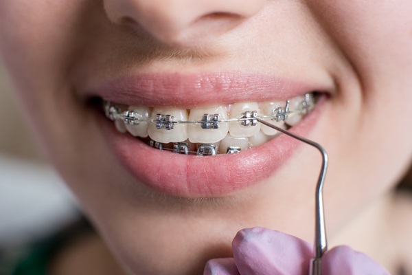 Macro shot of white teeth with braces. Female patient with metal brackets at the dental office.