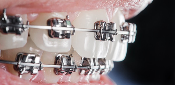 dental braces close up