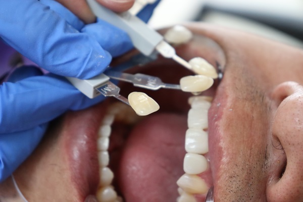 dentist testing veneers