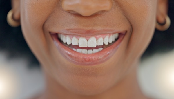 smiling woman with composite bonding