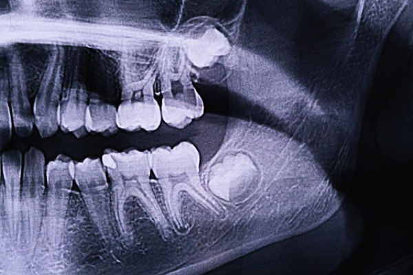 xray of an impacted wisdom tooth