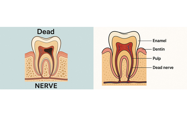 tooth with dead nerve