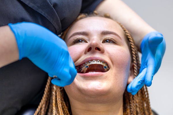 Dental procedure for installing braces close up. Dentistry. Braces on the teeth. High quality photo. Professional dental treatment. Doctor and patient.