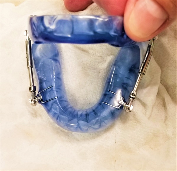 Mandibular Advancement Splint