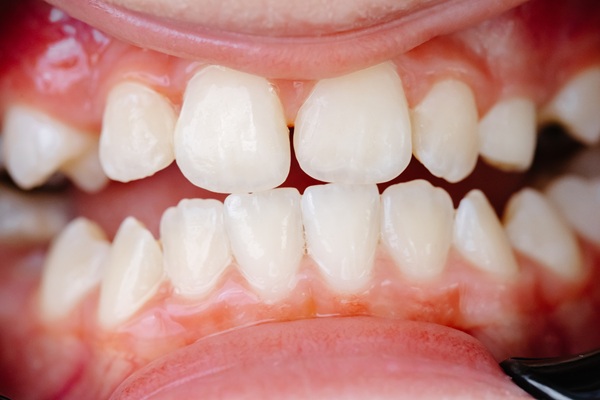 Young woman sitting in a dental chair, experiencing discomfort from tooth pain while waiting for treatment in a clinic