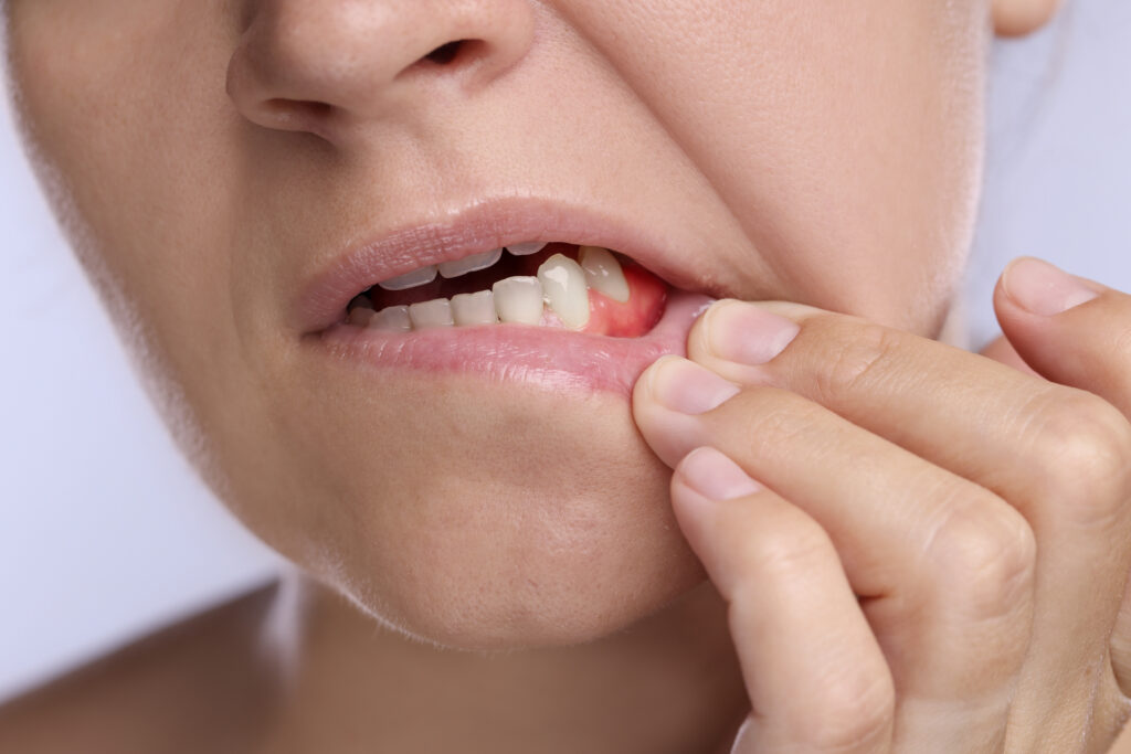 Dental abscess causing a painful pocket of pus in the tooth or surrounding gums.