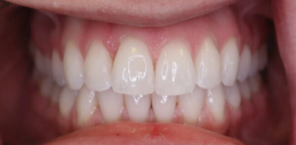Teeth 1 (1)