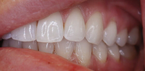 Teeth 2 (1)
